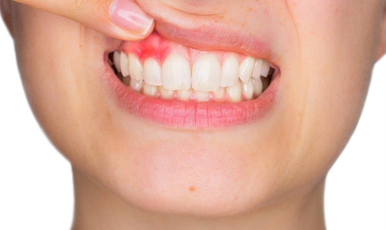 عفونت های دندانی